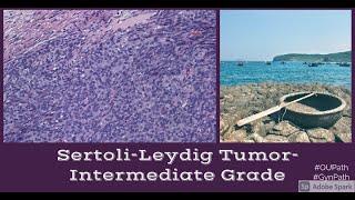 Sertoli Leydig Tumor, Moderately Differentiated