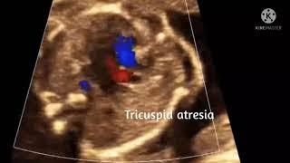 Case of tricuspid atresia with ventricular septal defect (TAVSD)