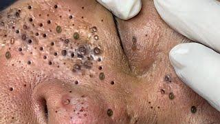 Big Cystic Acne Blackheads Extraction Blackheads & Milia, Whiteheads Removal Pimple Popping # 1426