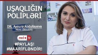 Usaqligin polipleri  (Uşaqlıq polipi) - Ginekoloq Aynura Abdullayeva / Medplus TV