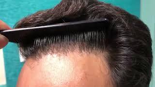 Brainstorming Hair Transplant Results | Best Hair Transplant Results- Dr. Jangid | New Delhi