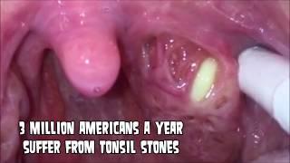 Extreme Tonsil Stone Removal