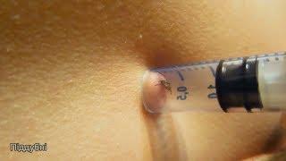 Можно ли вытащить КЛЕЩА шприцом Эксперимент КАК вытащить КЛЕЩА How to Remove a tick