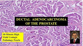 Ductal adenocarcinoma of the prostate