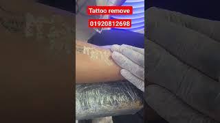 tattoo remove bd