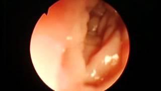 Erosive duodenitis.