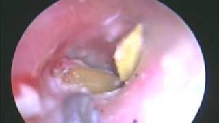 Endoscopic Foreign Body Removal from the Ear