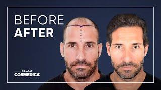 Hair transplantation in Turkey Istanbul Dr. Acar | Cosmedica Clinic  |  Best Result