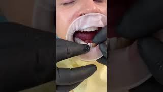 Dental Implant and Dental Crowns Treatment at Dentatur in Turkey #dentatur #smiledesignturkey