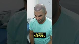 Amazing Hair Transplant Journey | Latest Fue Technique #shorts #viral #hair transplant