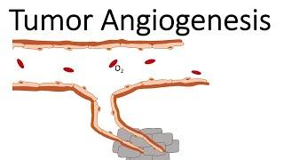 Tumor Angiogenesis