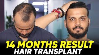 Hair Transplant in India | Best Results & Cost of Hair Transplant in India