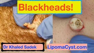 Dr Khaled Sadek. Blackhead Compilation. LipomaCyst.com