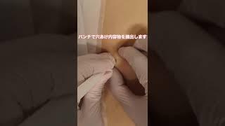 【粉瘤除去】くりぬき法で時短に【粉瘤手術】 #shorts