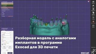 Разборная модель с аналогами имплантов в программе Exocad для 3D печати