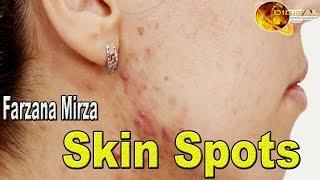 “Skin Spots” | Homemade Beauty Tips | Fashion Zone | HD Video