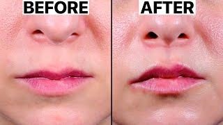 Best Lip Lift Surgery | 2023