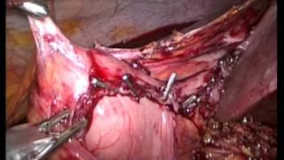 Laparoscopic Lysis Of Adhesions And Redo Of Gastrojejunostomy After Gastric Bypass