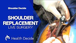 Shoulder Replacement Surgery (Shoulder Arthroplasty) - Live Surgery