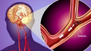 Stroke Prevention & Transient Ischemic Attack (TIA)