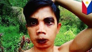 Plastic surgery gone wrong: Filipino model’s face ruined after $10 nose and chin job - TomoNews