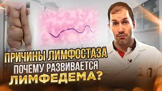 ПРИЧИНЫ ЛИМФОСТАЗА: Почему развивается лимфедема?