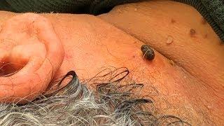 Jellyfish Neck Nevus