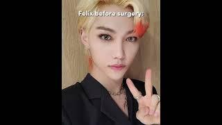 Felix before surgery  #straykids #shorts