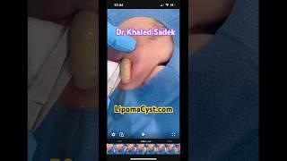 Massive infected cyst Dr Khaled Sadek lipomacyst.com