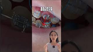 矯正醫師是不小心的，還是故意的#戴牙套