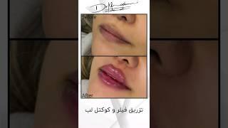 تزریق فیلر و کوکتل لب؛ فرمدهی لب #فیلر #زیبایی #تزریق_ژل #beauty #فیلر_لب #کوکتل_لب #دکتر_خادمی