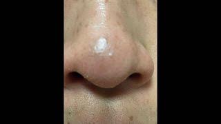 피지대마왕tv blackhead remover