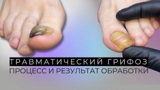 Травматический онихогрифоз. Травме 2 года. Пациентка - молодая девушка