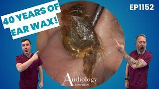 40 Years Of Ear Wax Blocking This Patient’s Ear! - EP1152