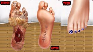 ASMR Treatment athlete's foot and warts Deep cleaning | Foot care animation