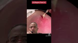 EXPLOSIVE ABSCESS#shorts