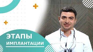  Этапы имплантации зубов: диагностика, сроки и особенности. Этапы имплантации зубов видео. 18+