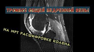 ТРОМБОЗ бедренной вены на РАСШИФРОВКЕ МРТ коленного сустава