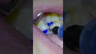 Dentist Performs White Resin Composite Filling on A Molar Tooth Class 1. #dentist #filling