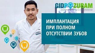 Имплантация при отсутствии всех зубов  какие есть варианты?