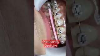 Orthodontic Dentistry|Fixed Braces|Dentistry life|Love Dentistry