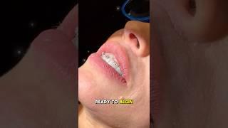 Getting Braces: Here’s How It Works 