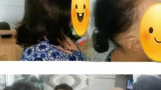 Antes e depois Prótese capilar