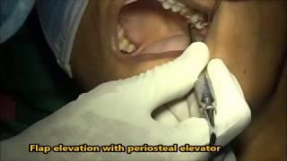 Extraction of upper wisdom tooth using cryers