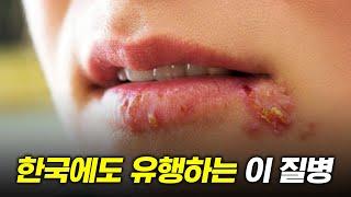 코로나가 불러온 의외의 질병