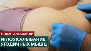 Иглоукалывание ягодичных мышц. Триггерные точки. Метод сухой иглы. Сокун Александр
