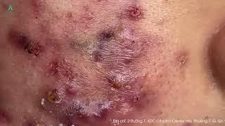 Big Cystic Acne Blackheads Extraction Blackheads & Milia, Whiteheads Removal Pimple Popping