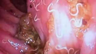 Pinworms found on colonoscopy