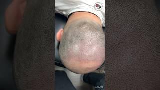 Процесс трихопигментации. Маскировка облысения, лысой макушки. Scalp micropigmentation