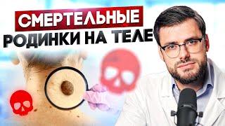 ОПАСНЫЕ РОДИНКИ: как распознать родинку вызывающую РАК?